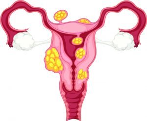 Calcified Uterine Fibroids Calcified Uterine Fibroids
