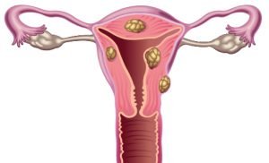 uterine fibroids uterine fibroids