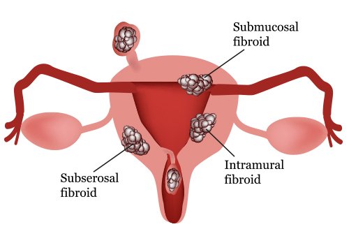 fibroid treatment for different types of uterine fibroids