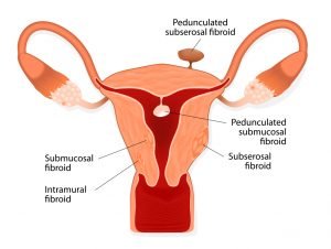 Fibroid Types Fibroid Types